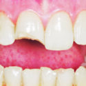 Mida teha, kui hammas on õnnetuses  ära tulnud või murdunud?